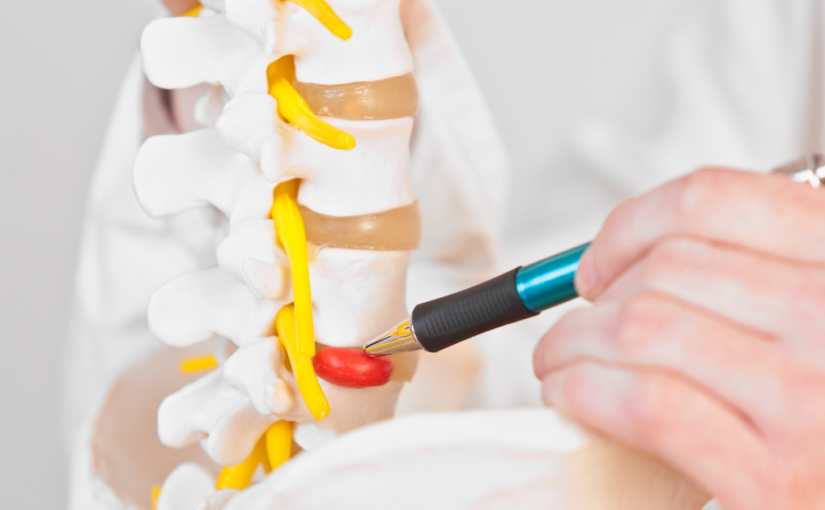 Disc Herniations