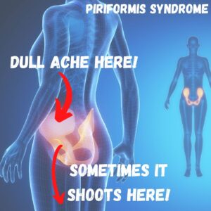 Piriformis Syndrome - Sarasota, FL: Schofield, Hand and Bright